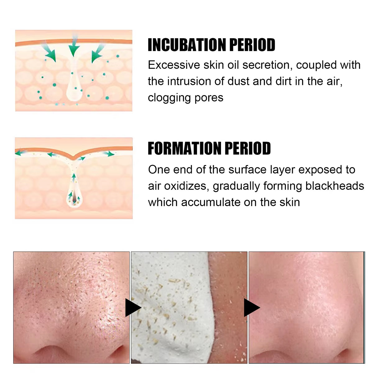 Blackhead Nose Patch Deep Cleansing, Nose Spots, Facial Spot Patch, Quickly Removes Blackheads, Restores Fresh Nose