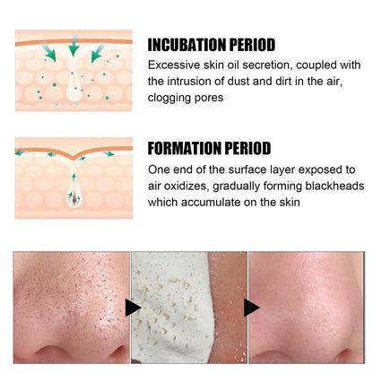 Blackhead Nose Patch Deep Cleansing, Nose Spots, Facial Spot Patch, Quickly Removes Blackheads, Restores Fresh Nose