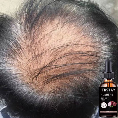 Onion Oil for Hair Growth Alopecia Hair Treatment for Women Treatment Fast Growing Hair Spray Essential Oil Protect